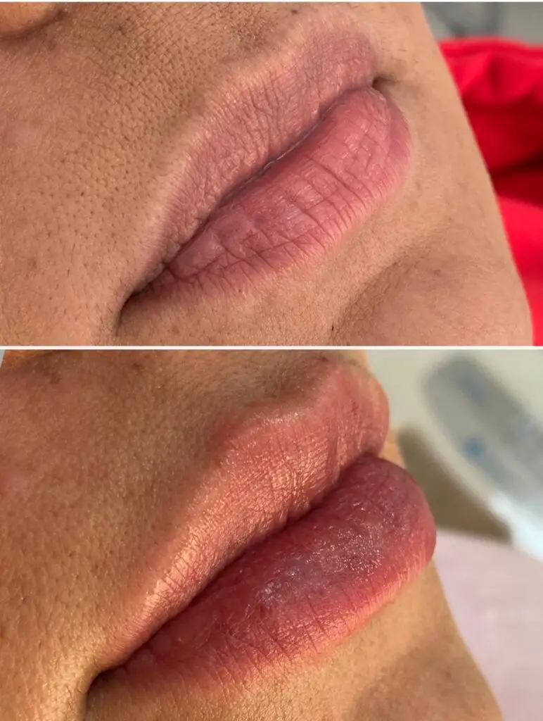 Preenchimento labial na Mooca na Clínica Dra. Heleny Corrêa para lábios naturais, hidratados e bem definidos