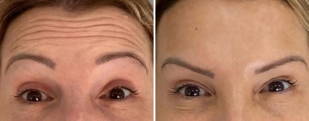 Aplicação de Botox na Mooca com Dra. Heleny Corrêa para suavizar rugas e linhas de expressão, abre o olhar.