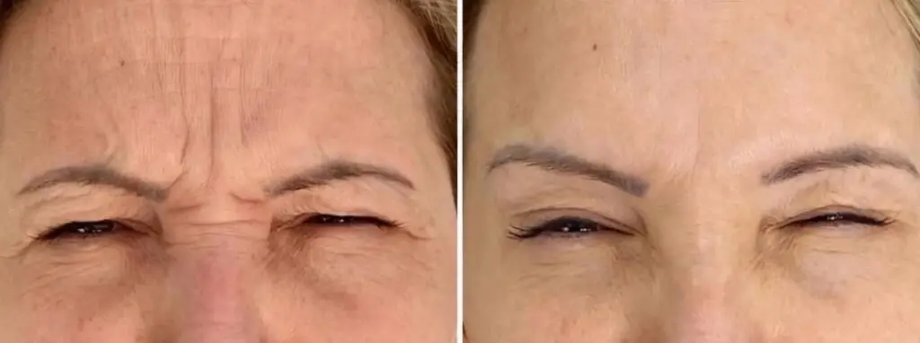 Aplicação de Botox na Mooca com Dra. Heleny Corrêa para suavizar rugas e linhas de expressão