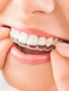 sorriso com Invisalign