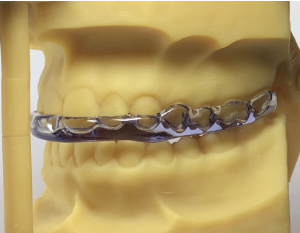 Placa de bruxismo impressa em modelos 3D