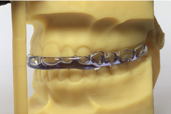 Placa de bruxismo impressa em modelos 3D